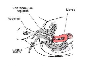Схема выскабливания цервикального канала и полости матки